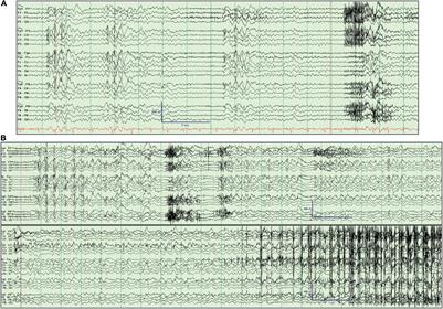 Centromedian Nucleus of the Thalamus Deep Brain Stimulation for Genetic Generalized Epilepsy: A Case Report and Review of Literature